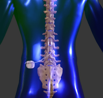 Spinal Cord Stimulator Trials